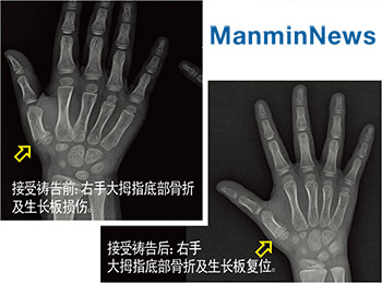 "儿子的大拇指骨折和生长板损伤完全得蒙医治!